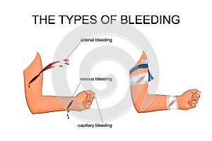 The types of bleeding photo