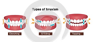 Types of bruxism teeth grinding vector illustration