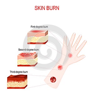 Types of burns. Cross section of humans skin