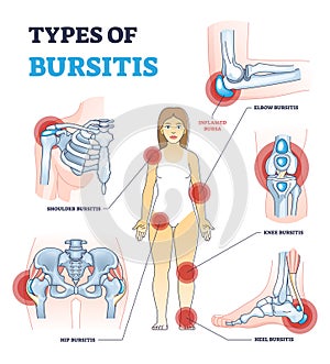 Types of bursitis as medical body joints inflammation list outline diagram photo