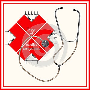 Types of cardiac arrhythmia: sinus tachycardia, sinus arrhythmia