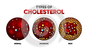 Types Cholesterol in flat style. LDL and HDl level. Arteriosclerosis, infarct, ischemia, thrombosis disease. Cholesterol photo
