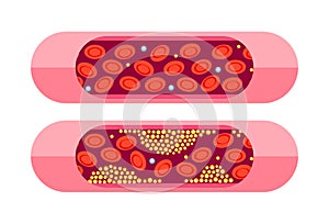 Types of cholesterol. HDL and LDL cholesterol types. Labeled educational normal and narrowed artery. Vector illustration