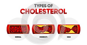 Types Cholesterol. LDL and HDl level. Arteriosclerosis, infarct, ischemia, thrombosis disease. Cholesterol in human