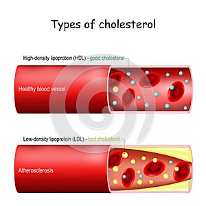 Types of cholesterol. Normal and narrowed artery