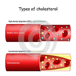 Types of cholesterol. Normal and narrowed artery photo