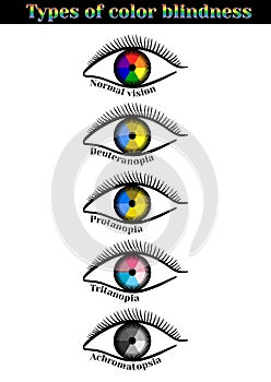 Types of color blindness.