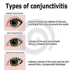 Types of conjunctivitis