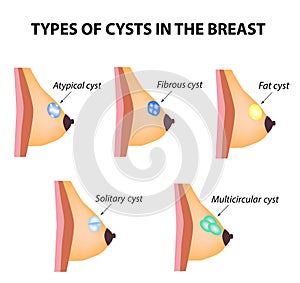 Types of cysts in the breast. Atypical, Fibrous, Fatty cyst, Solid cyst, Multicameral. World Breast Cancer Day. Tumor. Set. Vector