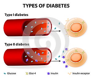 Types of Diabetes