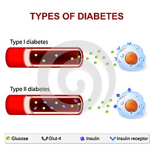 Types of Diabetes