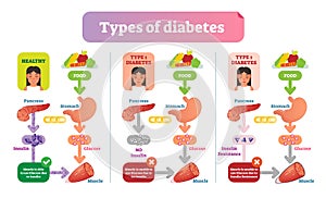 Types of Diabetes simple medical vector illustration scheme. Health care information diagram.