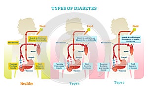 Types of diabetes vector illustration diagram scheme