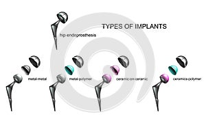 Types of endoprostheses by type of material