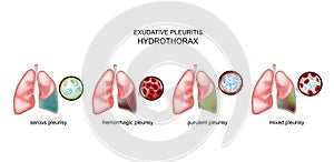 Types of exudative pleurisy and hydrothorax