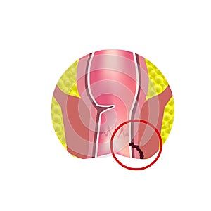 Types of fistulas of the rectum. Paraproctitis. Anus. Abscess of the rectum. Infographics. Vector illustration