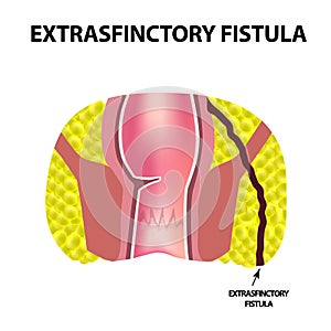 Types of fistulas of the rectum. Paraproctitis. Anus. Abscess of the rectum. Infographics. Vector illustration