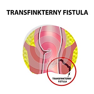 Types of fistulas of the rectum. Paraproctitis. Anus. Abscess of the rectum. Infographics. Vector illustration