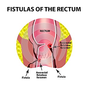 Types of fistulas of the rectum. Paraproctitis. Anus. Abscess of the rectum. Infographics. Vector illustration