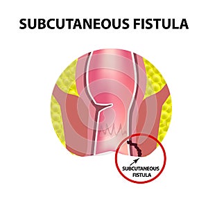 Types of fistulas of the rectum. Paraproctitis. photo