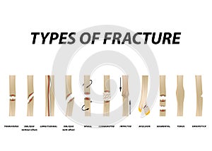 Types of fracture. Fracture bone set. Infographics. Vector illustration on isolated background. photo