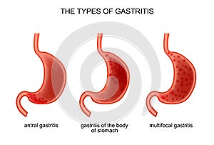 The types of gastritis