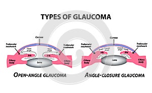 Types of glaucoma. Open-angle and angle-closure glaucoma. The anatomical structure of the eye. Infographics. Vector