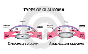 Types of glaucoma. Open-angle and angle-closure glaucoma. The anatomical structure of the eye. Infographics. Vector photo