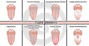 Types glossitis. Inflammatory disease tongue photo
