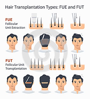 Types of hair transplantation FUE and FUT