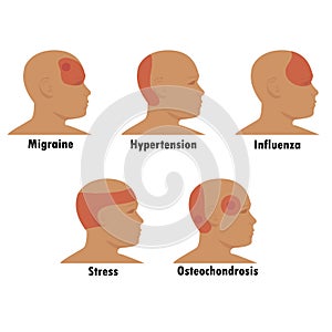 Types of headaches. Schematic representation of foci of headache in stress, flu, osteochondrosis, hypertension. Migraine.