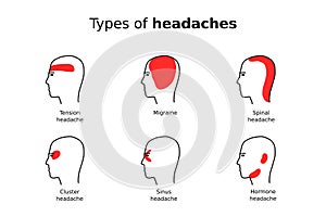 Types of headaches vector infographic