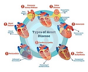 Types of heart disease collection, vector illustration diagram. Educational medical information.