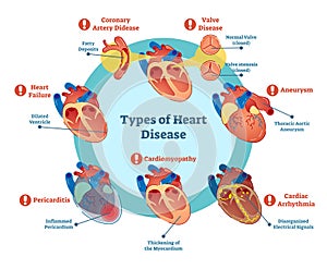 Types of heart disease collection, vector illustration diagram. Educational medical information. photo