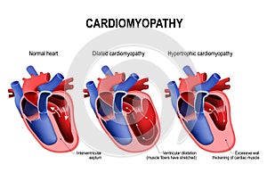 Hypertrophic cardiomyopathy, dilated cardiomyopathy and healthy photo
