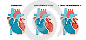 Types of heart diseases - normal, hypertrophic and dilated cardiomyopathy. Human heart muscle diseases cross-section.