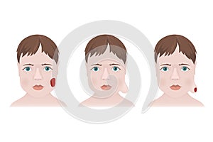 Types of hemangiomas on the face of a child.