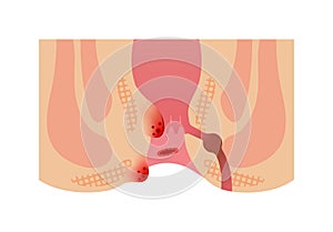 Types of Hemorrhoid flat vector illustration  no text photo