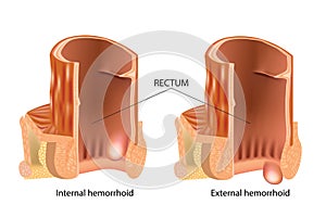 Types of Hemorrhoids. Hemorrhoids, also called piles photo