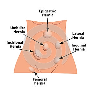 Types of hernia. Epigastric, Lateral, Umbilical, Inguinal, femoral, incisional hernia. intestinal hernia. Infographics. Vector