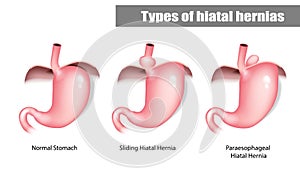 Types of hiatal hernias sliding and paraesophageal.