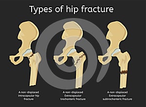 Types of hip fracture