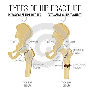 Types of hip fracture