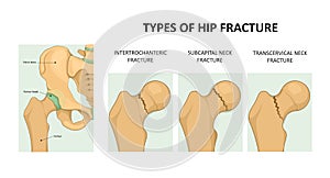 Types of hip fracture. Femoral neck fracture. photo