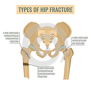 Types of hip fracture photo