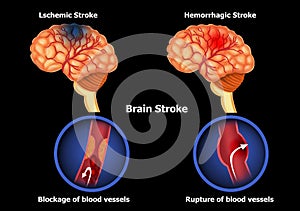 Types of human brain stroke