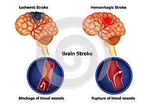 Types of human brain stroke