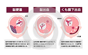 Types of human brain stroke vector illustration