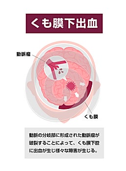 Types of human brain stroke vector illustration | Subarachnoid hemorrhage