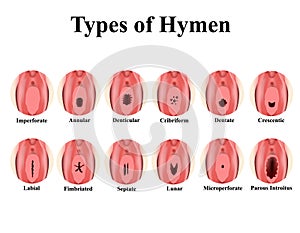 Types of hymen. Imperforate, annular, Denticular, Cribriform, dentate, Crescentic, Labial, Fimbriated, Septate, lunar